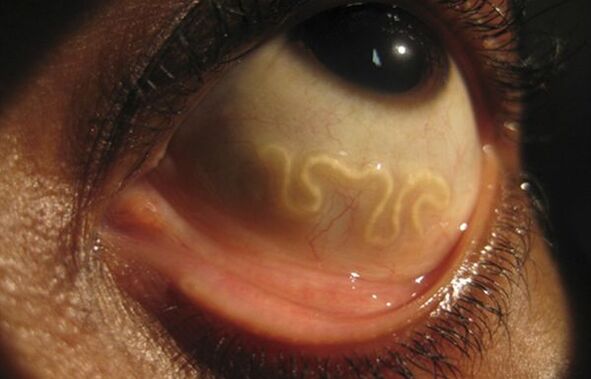 Loa Loa 蠕虫生活在人眼中并导致失明